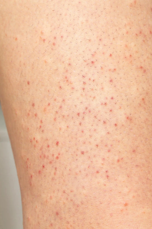 Folliculitis After Waxing: Causes, Prevention, and Effective Treatments