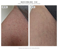 Before and after comparison of skin after hair removal, showing red, irritated skin on the left and clearer, calmer skin on the right after using Black Coral Wax USA ili Oil 60ml Ingrown Oil to soothe ingrown-prone skin.